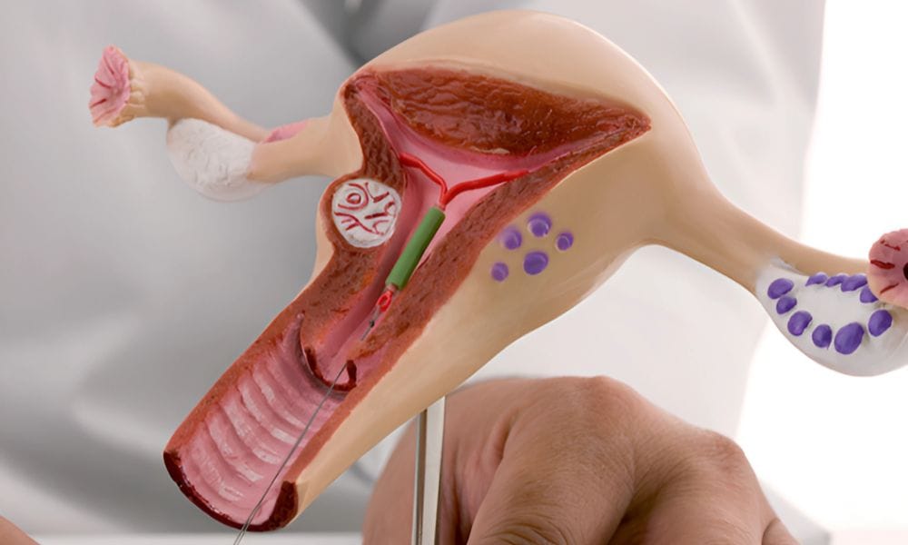 IUI Treatment in Mumbai